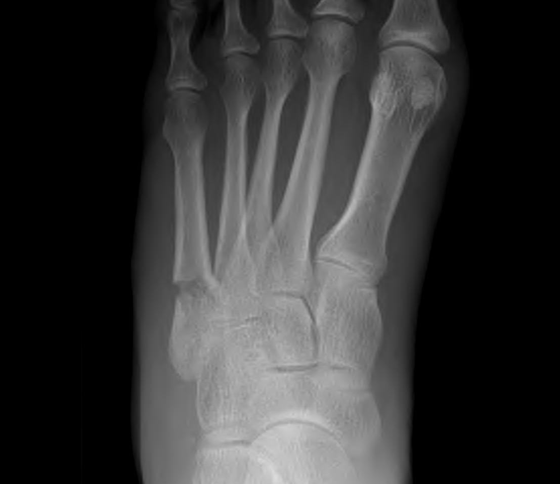 Jones Fracture